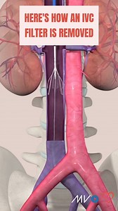 14K views · 64 reactions | Why retrieve an IVC filter? Retrievable...