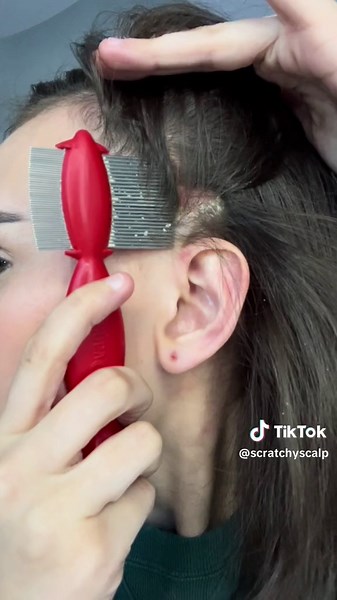 i feel like nara smith the way i make my psoriasis from scratch so easily 😭 #psoriasis #scalppsoriasis #psoriasisremoval #satisfyingremoval #Psoriasispatches #scalppsoriasisremoval #psoriasisawareness #psoriasismanagement #psoriasiscommunity #psoriasistreatment #psoriasishelp #psoriasistok #scalppsoriasisrelief