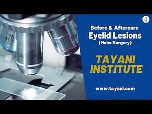 Before & After Eyelid Lesions (Mohs Surgery) | Tayani Institute