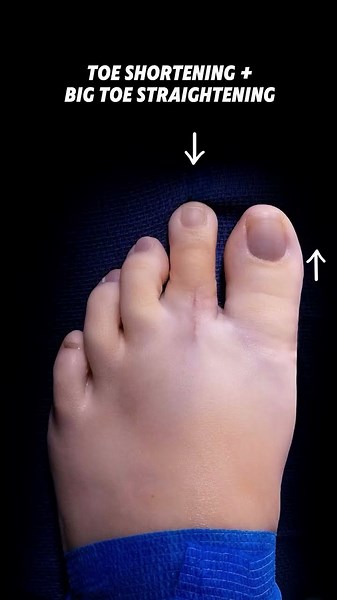TOE SHORTENING + BIG TOE STRAIGHTENING SURGERY AT LUXE FOOT SURGERY