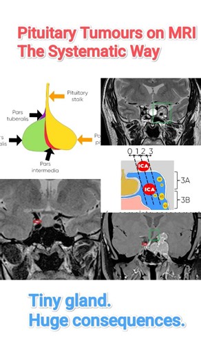 Adeel Ur Rehman | Pituitary Tumors on MRI — A Systematic Survival Guide 🧠 Pituitary neuroendocrine tumors (PitNETs), formerly called pituitary adenomas, are... | Instagram