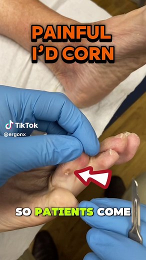 Understanding and Treating Painful Corns Between Toes