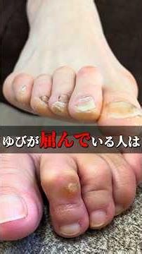 How to Fix Hammertoes