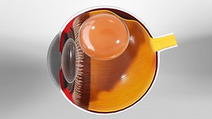 Pneumatic Retinopexy | Treatments for Retinal Detachment