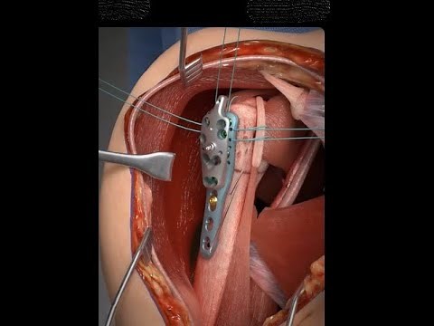 Proximal Humerus Fracture. (ORIF-Through the Deltopectoral Approach)