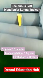Deciduous Left Mandibular Lateral Incisor | Tooth Morphology