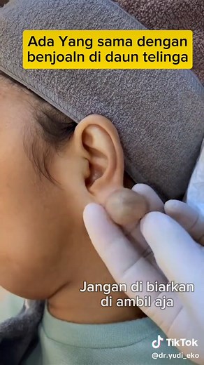Benjolan di Daun Telinga: Penyebab dan Pengobatan