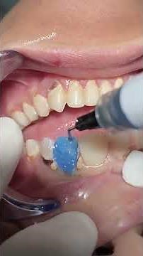 Deep caries with Composite veneer #dentist