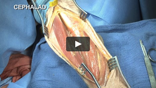 Anterolateral Plating of the Humeral Diaphysis - Raymond Pensy, MD