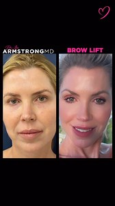 Is a brow lift always surgical? NO! Brows can be lifted non-surgically in the office with Tox, threads, or both! That’s what I did 💁‍♀️ | Jennifer Armstrong, MD