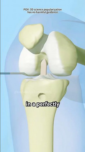 ACL Reconstruction Surgery (3D Animation)