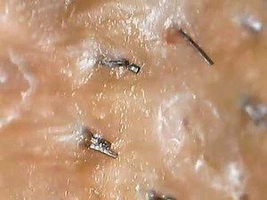Ingrown hairs plucking