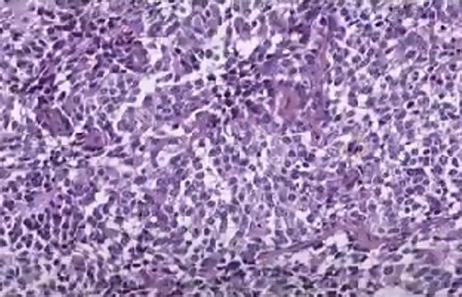 Rare Disease Day 2024: How IARC is tackling rare cancers