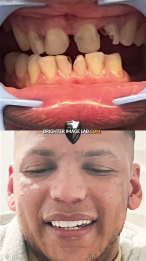 No One Is Talking About How To Get Your Teeth To Look Like This #veneers #beforeandafter #dentistry