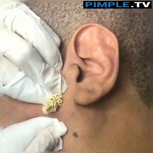 Big Cystic Acne Large Blackheads Extraction Blackheads Whiteheads Removal Pimple Popping P48 #Shorts