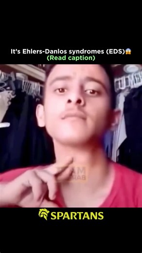 Medical | Science | Facts | Ehlers-Danlos syndrome (EDS) is a condition characterized by extremely flexible joints, including fingers that can bend beyond the normal... | Instagram