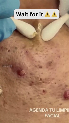 Large Blackheads Extraction Big Cystic Acne Blackheads&Whiteheads Removal Pimple Popping #1117 2026