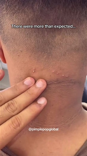 The Most Satisfying Blackheads Removals Revealed