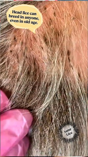 28K views · 134 reactions | At his old age, he had so many head lice that his family was forced to take him to undergo lice removal treatment. #Lice #RemovalLice #AsmrVideo #Piojos #Satisfying | Ahmad | Facebook