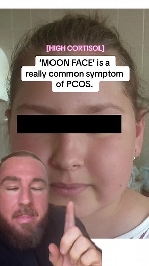 HIGH CORTISOL] Is Your PCOS Causing 'Moon Face'? Find Ways to Improve Symptoms | PCOS Awareness