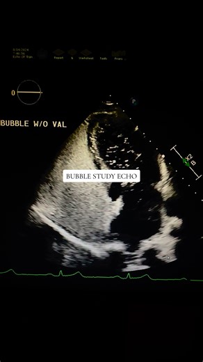 Positive bubble study #echotech #echocardiography #cardiology #cardiacsonography