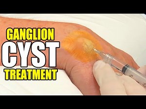 Jailbird's Ganglion Cyst, Treatment with Dr. John Gilmore