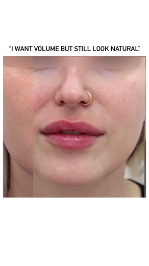 Natural Volume with Lip Fillers