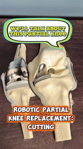 Partial knee replacement isn’t “half a knee replacement.” It’s millimeter-level surgery in a tiny space. The robot doesn’t operate — it gives me guardrails so I can remove arthritis while preserving your natural knee. Small surgery. Big precision. #PartialKneeReplacement #KneeArthritis #RoboticSurgery
