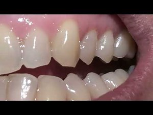 Teeth Extreme Close Up