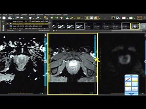 Prostate MRI Case Review: A Case Example of PI RADS Designation Assessment