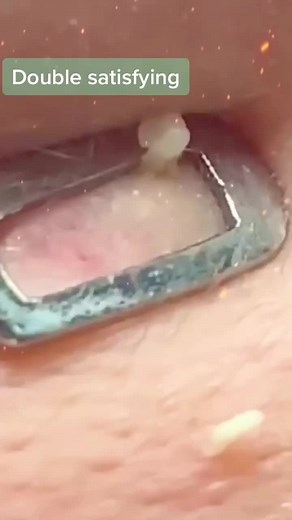 #greenscreenvideo #yoyomcn #pimplepopping #pimpleremover #extractions #pimple #zitpopper Double satisfying