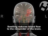 Brain Injury • Video • MEDtube.net