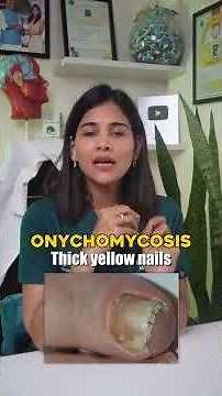 Yellow nail syndrome → Lymphedema, chronic respiratory disorders, pleural effusions