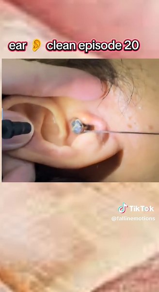 Ear Clean Up Challenge: Episode 20 Insights