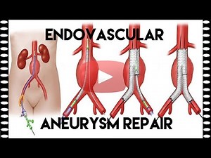 What is EVAR or Endovascular Aneurysm Repair | Medical Coding Tips