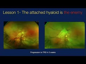 Lecture: Lessons Learned in Diabetic Retinopathy