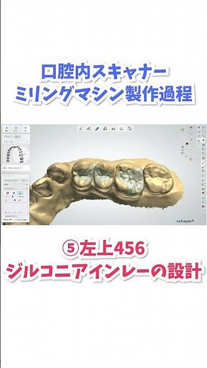 最先端の口腔内スキャナー・ミリングマシンの作製過程🦷 #歯医者 #歯科衛生士 #たぼ歯科 #さいたま市 #浦和 #作製