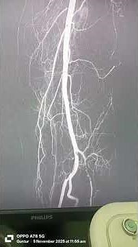 POPLITEAL ARTERY INTERVENTION : DR. AKIF BAIG