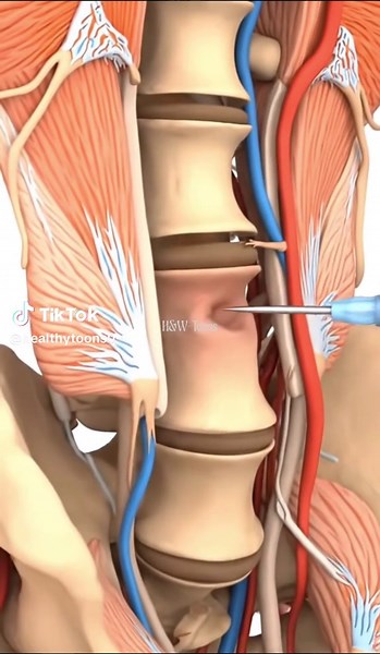 This 3D animation provides a detailed, educational view of a lumbar spinal injection. It begins with a cut-away perspective of the lumbar vertebrae, showing the vertebrae, intervertebral discs, spinal cord, and exiting nerve roots. A precise needle is guided through the relevant tissue layers into the epidural space. The animation highlights an inflamed nerve root, previously irritated and shown in red, as it is bathed in therapeutic medication, visually demonstrating how the treatment reduces i