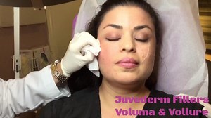 Filler treatment on cheeks and smile lines