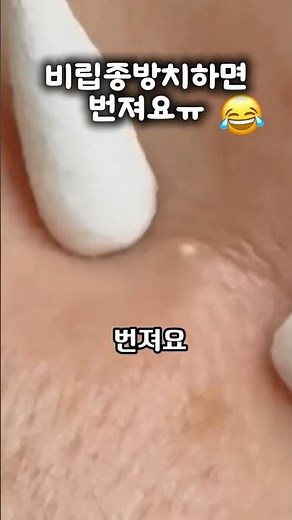 비립종 방치하면 얼굴전체로 번져요 .각질이 쌓여서 피지분비가 많아서 쌓이는 비립종 함부로 제거하면 상처 나요.꼭 픽시카겔 발라주세요 #비립종압출 #상처보호겔