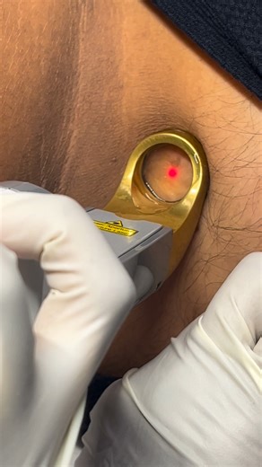 Skin tags are common, harmless skin growths that appear as small, soft, flesh-coloured or slightly pigmented bumps. They’re made up of loose collagen fibres and tiny blood vessels covered by skin. They often form in areas where the skin experiences regular friction—such as the neck, underarms, eyelids, and groin. Although they’re generally painless, skin tags can become irritated if they rub against clothing or jewellery. If you’re concerned about skin tags or would like personalised advice, con