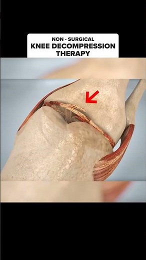 Knee Pain Isn't Permanent! 😲 How Knee Decompression Therapy Reduces Joint Pressure #Shorts #kneepain