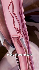 13M views · 149K reactions | What To Do If You Get A Nosebleed 樂 | Zack D. Films | Facebook