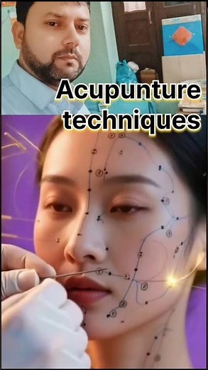 Acupunture techniques treatment || acupuncture therapy || acupuncture for tcm points treatment #tcm