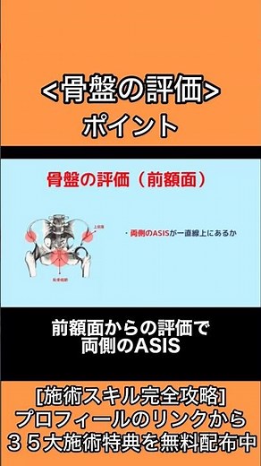 骨盤のアライメント評価をするには上前腸骨棘(ASIS)と上後腸骨棘(PSIS)がポイントです。前額面では左右の上前腸骨棘が一直線上にあるかをみます。矢状面では前後の腸骨棘で骨盤の前・後傾をみます。