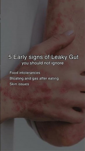 5 Early Signs of Leaky Gut