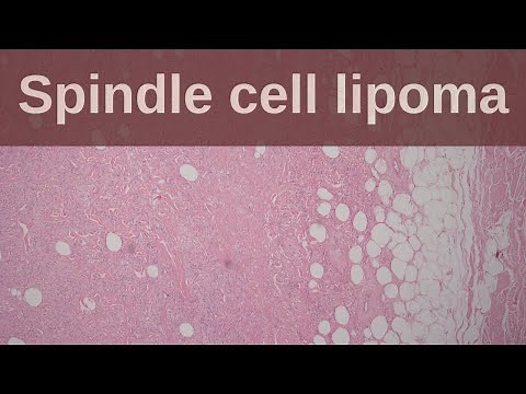 Spindle Cell Lipoma - Pathology mini tutorial