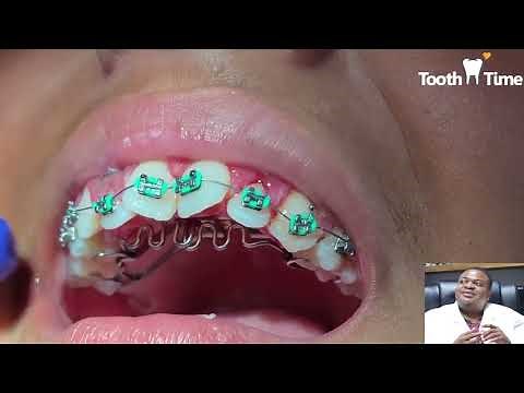 Dental Braces: Tongue Crib + RPE - Tooth Time New Braunfels Texas Orthodontics
