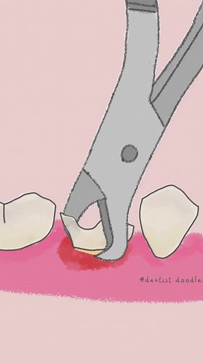 Cuidados Post-Extracción Dental: Lo Que Necesitas Saber